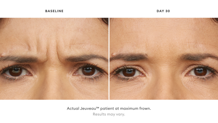 Jeuveau patient before and after treatment while frowning