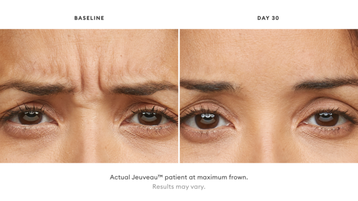 Jeuveau patient before and after treatment while frowning
