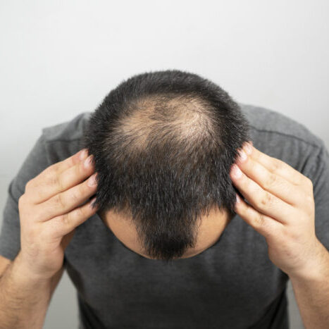 prp hair treatment for men